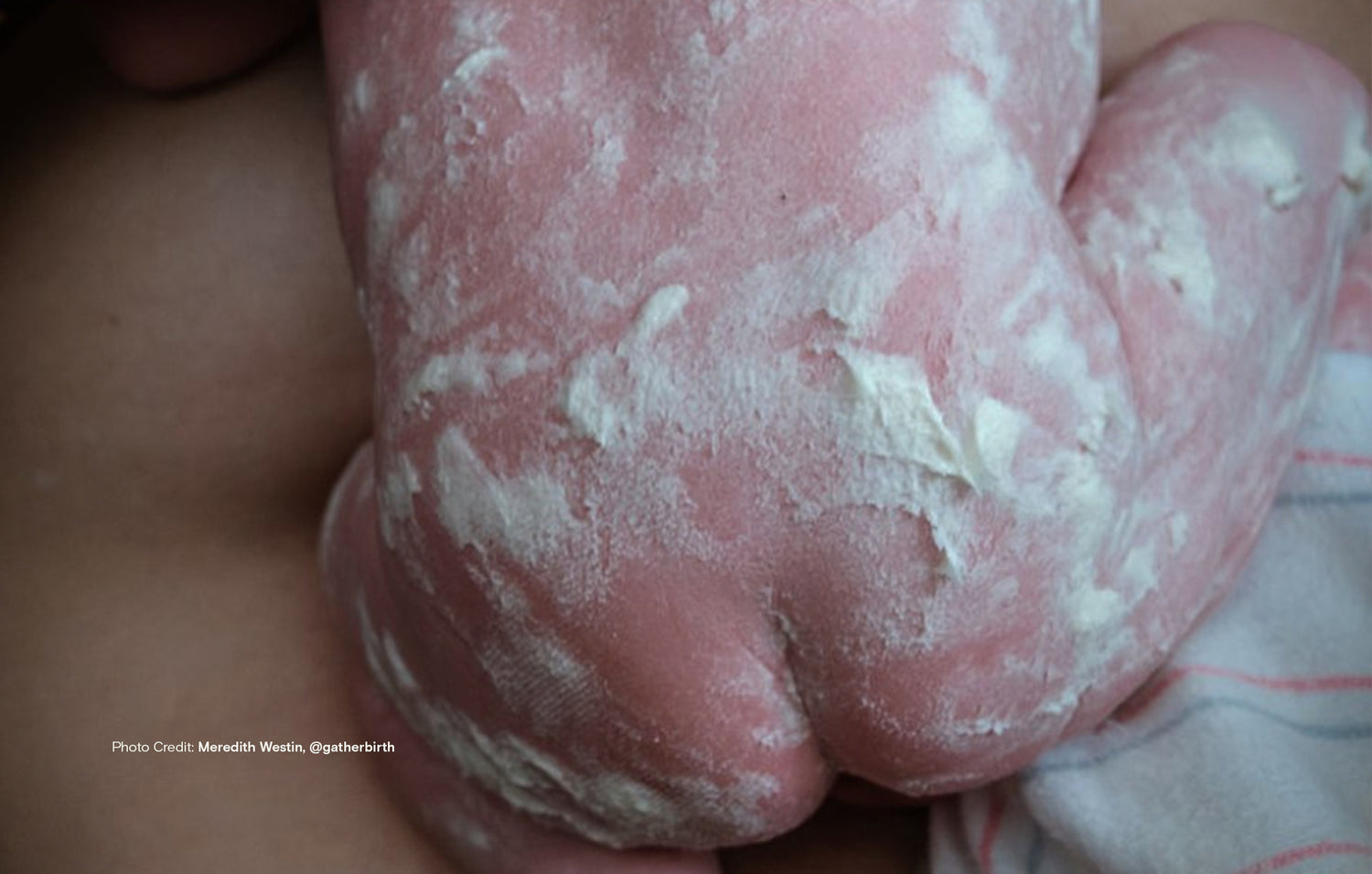 Baby covered in Vernix.